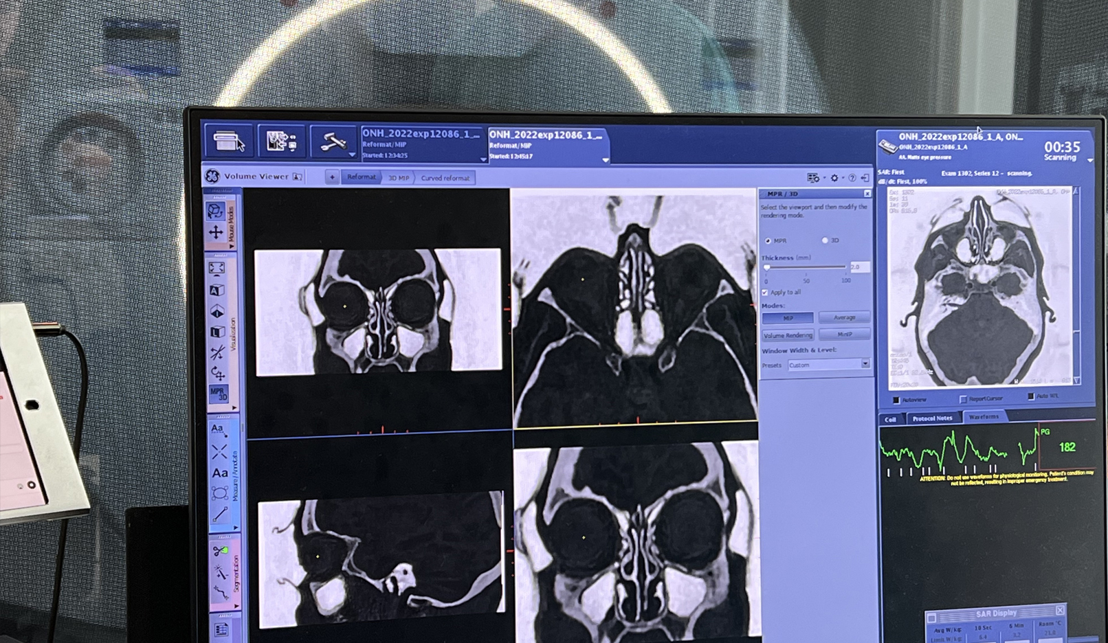 Optic Nerve - Glaucoma