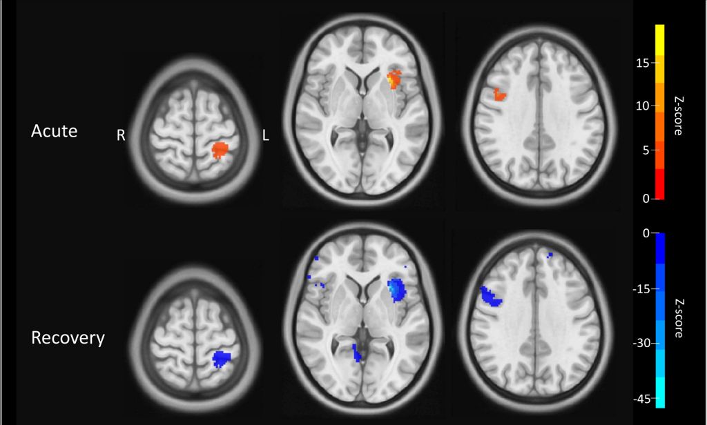 New AUT Concussion Research Could Revolutionise Understanding And Recovery